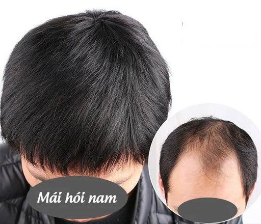 Mái Hói Nam Bằng Tóc Thật Không Da & Siêu Da Đầu TTN-01